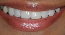 best teeth whitening India