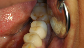 Implant Dentist Mumbai